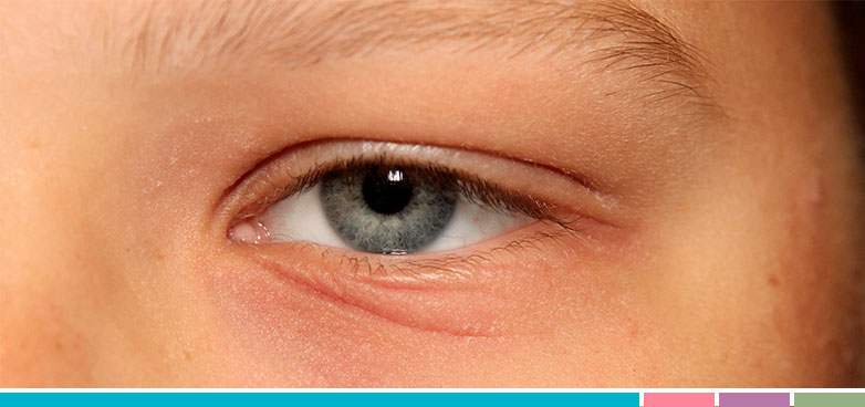 Ahora Numérico Decano Dermatitis atópica también en los ojos